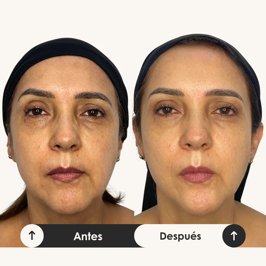 surco nasogeniano